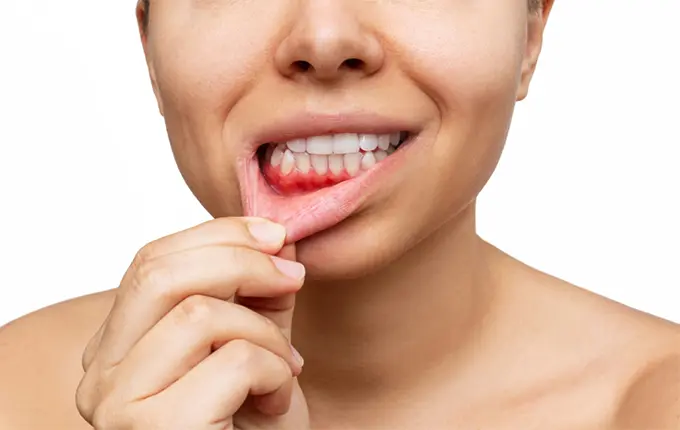 دلیل خونریزی لثه در خواب و اول صبح چیست؟