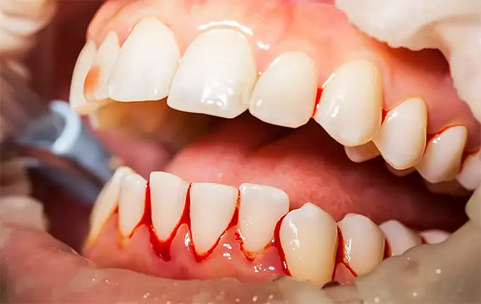 علت خونریزی لثه چیست؟