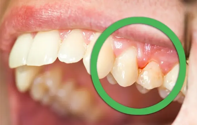 8 دلیل مهم خونریزی لثه