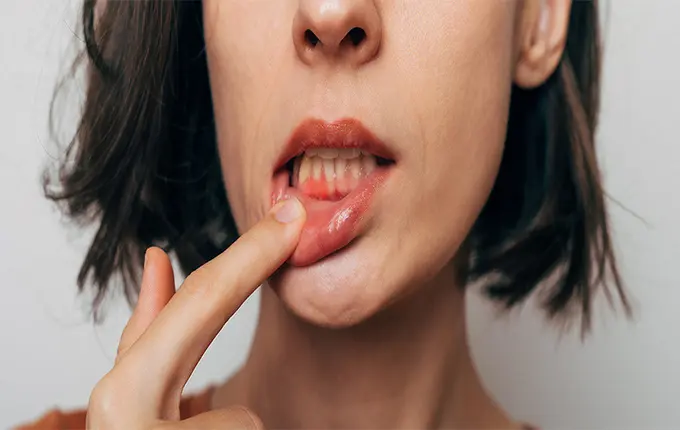 علت خونریزی لثه چیست؟