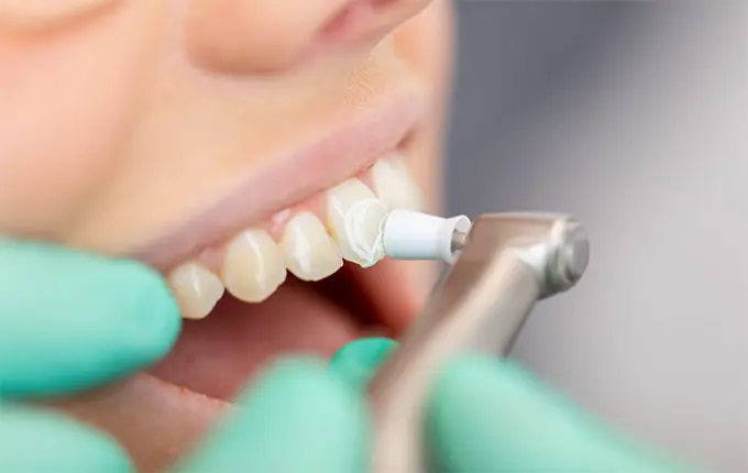 تفاوت بلیچینگ با جرم گیری دندان چیست؟