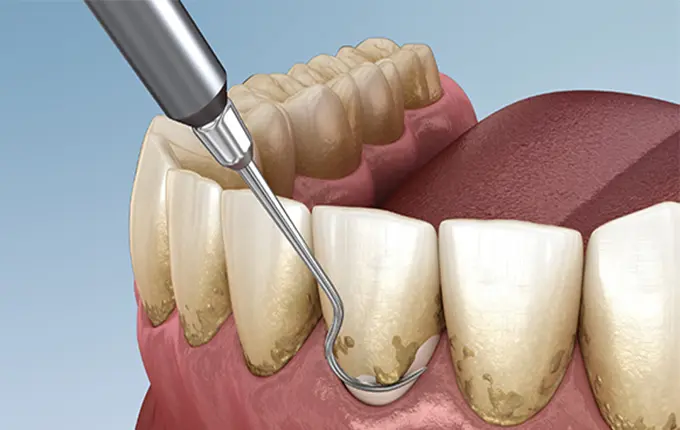 حفظ نتایج بلیچینگ و جرم گیری