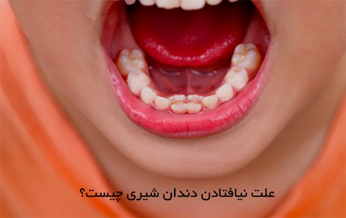 علت نیافتادن دندان شیری چیست؟