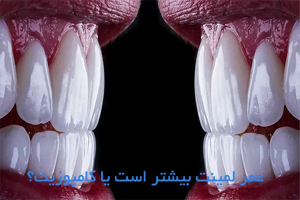 عمر لمینت بیشتر است یا کامپوزیت؟
