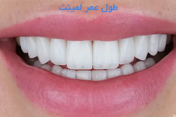 طول عمر لمینت دندان