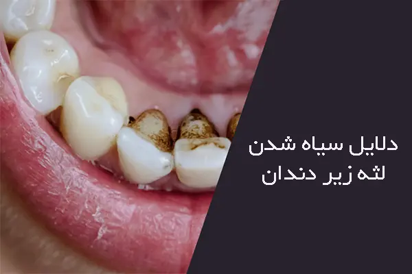 علت سیاه شدن لثه زیر دندان