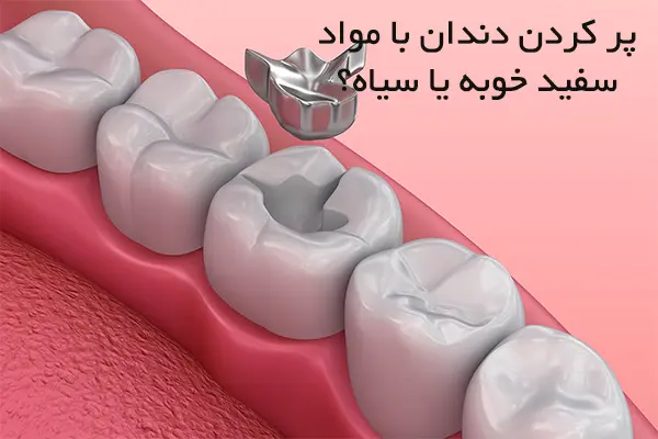 پر کردن دندان با مواد سفید خوبه یا سیاه؟