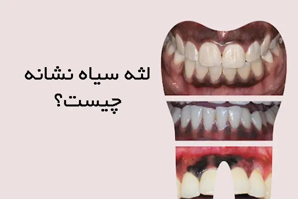 لثه سیاه نشانه چیست؟