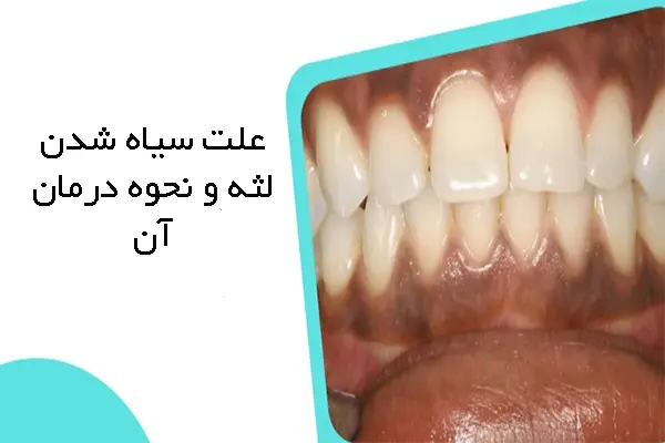 علت سیاه شدن لثه و نحوه درمان آن