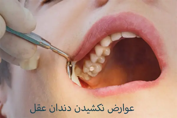 چرا باید دندان عقل نهفته را کشید؟