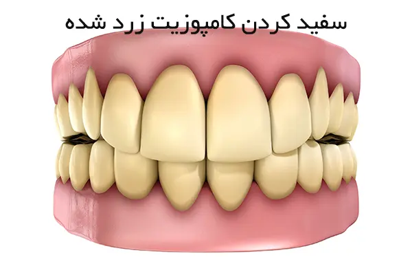 چگونه دندان کامپوزیت شده را سفید کنیم؟