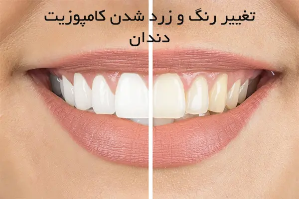 چگونه از تغییر رنگ کامپوزیت جلوگیری کنم؟