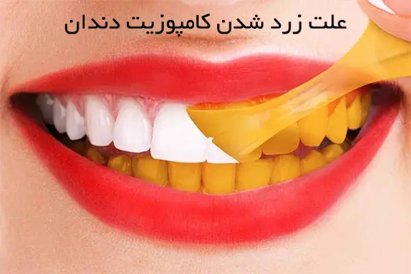 5 علت تغییر رنگ و زرد شدن کامپوزیت دندان