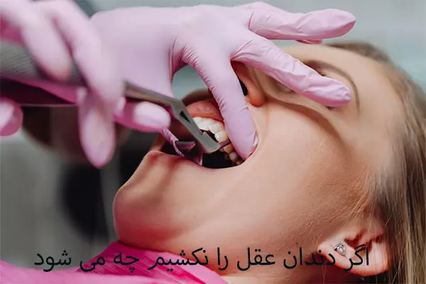 عوارض نکشیدن دندان عقل