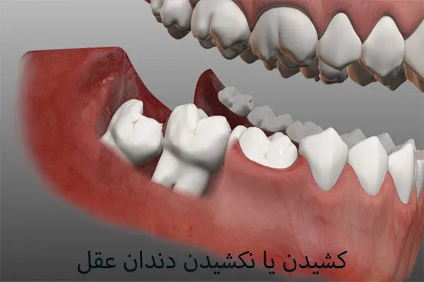 7 مورد از عوارض نکشیدن دندان عقل 