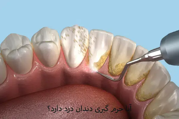 آیا جرم گیری دندان درد دارد؟