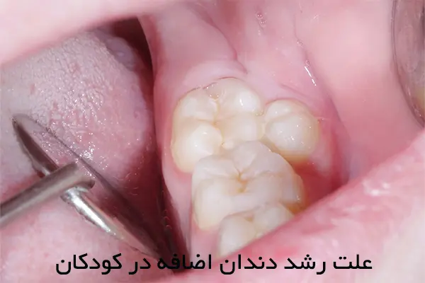 علائم دندان اضافی در کودکان