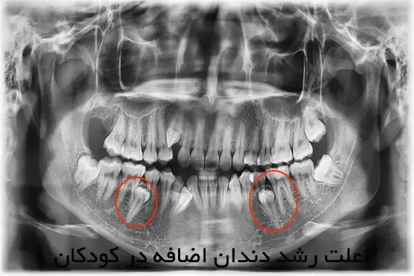 علت رشد دندان اضافه در کودکان و راه درمان آن