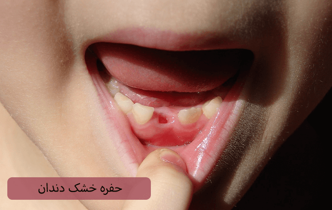 حفره خشک دندان