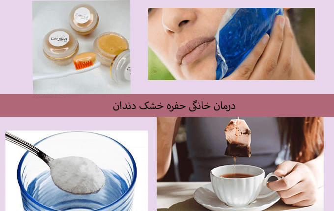 درمان خانگی حفره خشک دندان