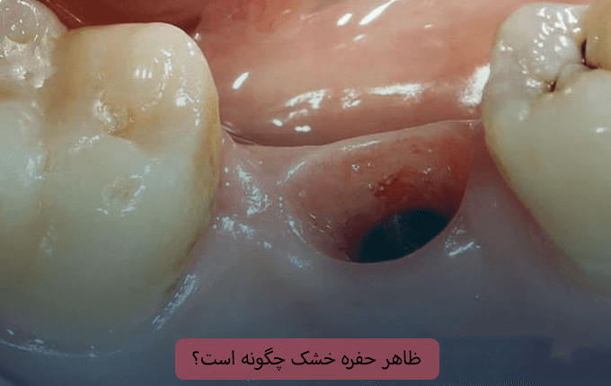 ظاهر حفره خشک چگونه است؟