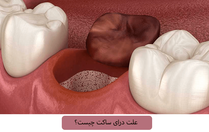 علت درای ساکت چیست؟