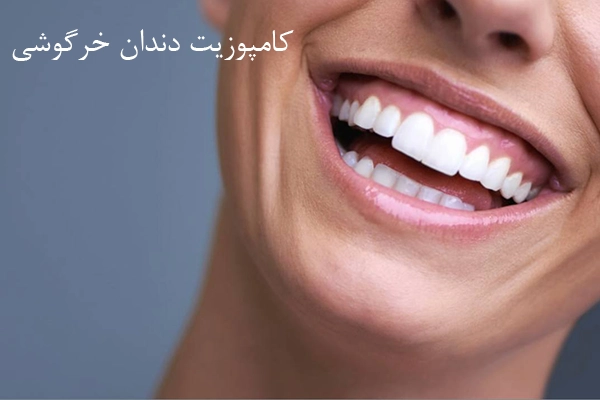کامپوزیت دندان خرگوشی چیست؟