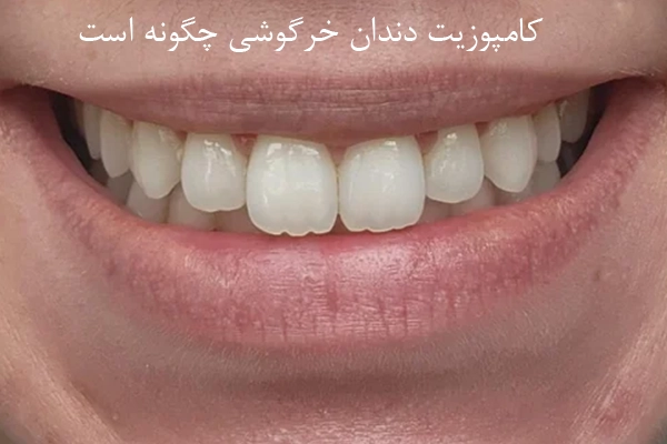 کامپوزیت دندان خرگوشی برای چه کسانی مناسب نیست؟