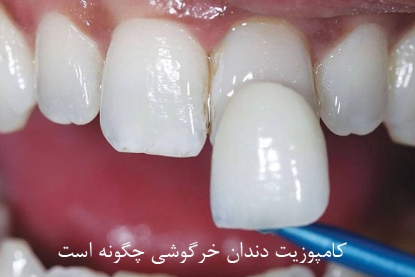 کامپوزیت دندان خرگوشی
