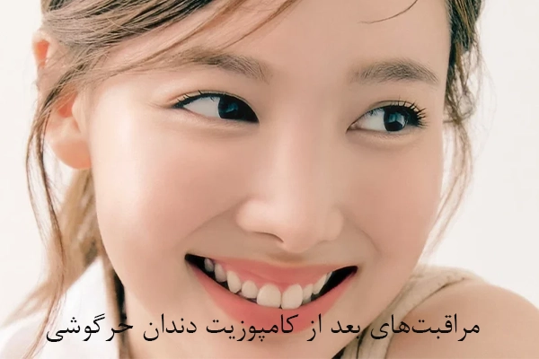 مراقبتهای بعد از کامپوزیت دندان خرگوشی